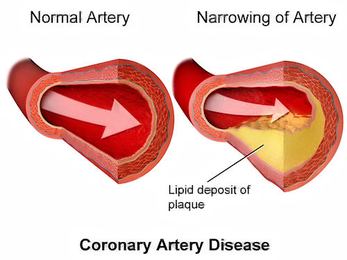 cholesterol in arteries